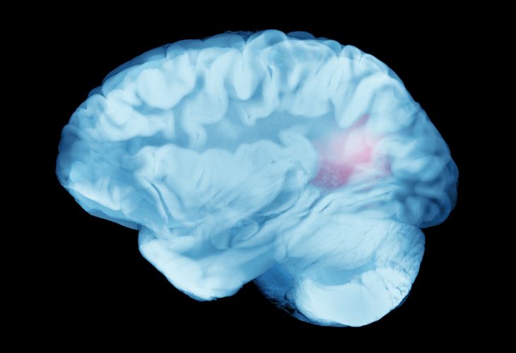 Aneurisma cerebral: conheça os sinais de alerta